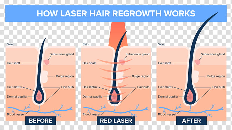 Hair, Laser, Hair Loss, Hair Follicle, Diagram, Wavelength, Medicine, Angle transparent background PNG clipart