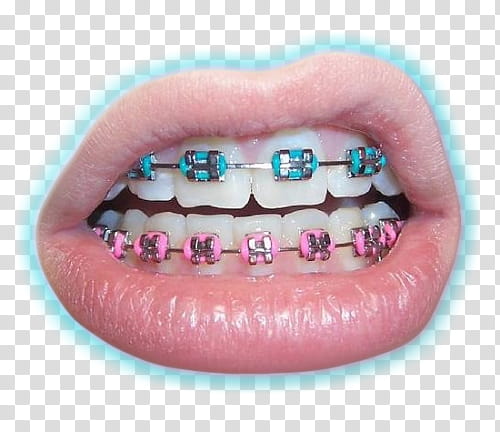 , teeth braces transparent background PNG clipart